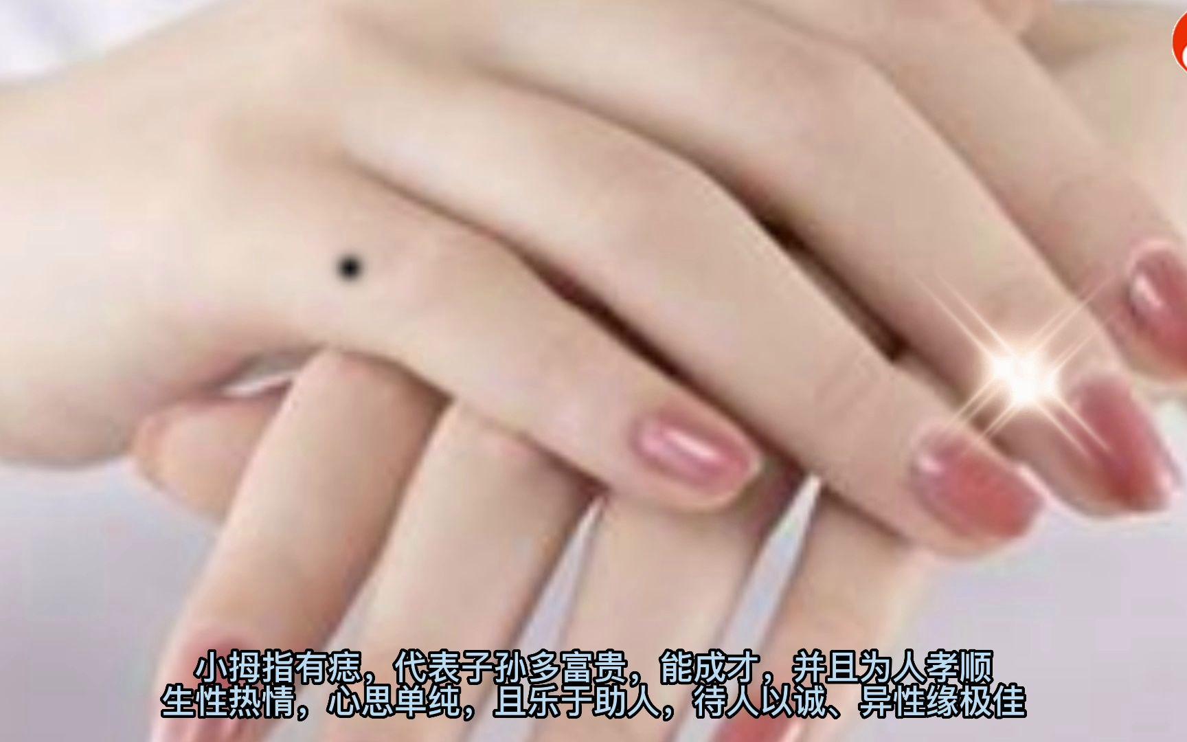 女人左手小拇指有痣全图解(女孩左手小拇指有痣代表什么意思) 女人左手小拇指有痣全图解(女孩左手小拇指有痣代表什么意思)