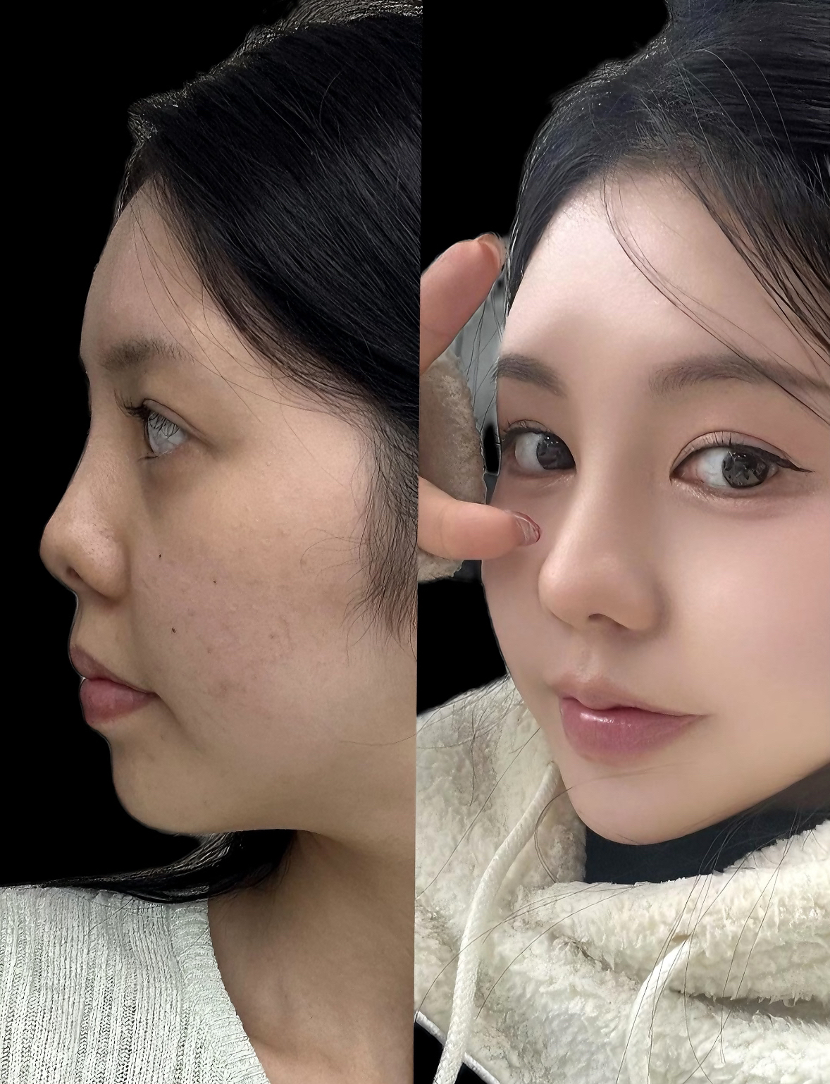女人鼻子大鼻头肉多好不好的简单介绍 女人鼻子大鼻头肉多好不好的简单介绍