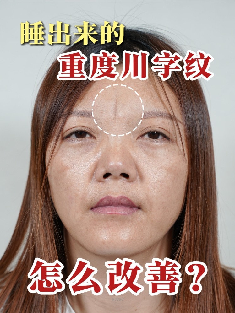 额头上有川字纹好吗(额头上有川字纹怎么办?) 额头上有川字纹好吗(额头上有川字纹怎么办?)