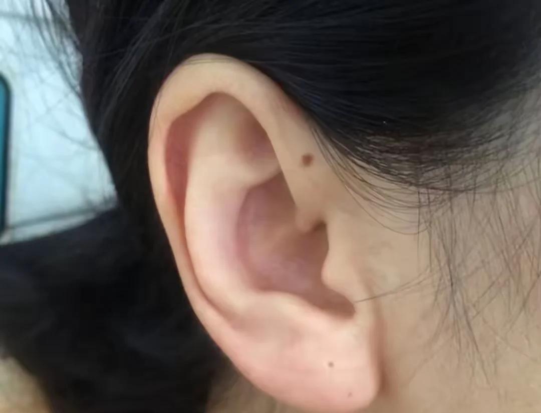 女人右耳垂下方有个痣好不好(女人右耳垂下方有个痣好不好图片) 女人右耳垂下方有个痣好不好(女人右耳垂下方有个痣好不好图片)