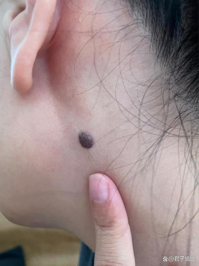 女人左锁骨有痣穷一辈子(女子左边锁骨上有痣是好还是不好) 女人左锁骨有痣穷一辈子(女子左边锁骨上有痣是好还是不好)