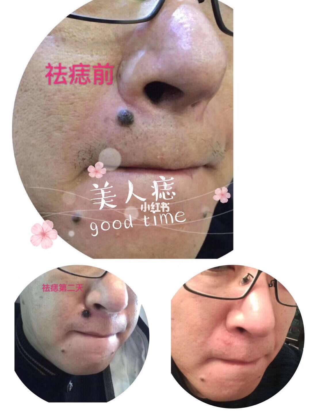 三颗痣连成一个三角形(三颗痣连成一个三角形在脖子上) 三颗痣连成一个三角形(三颗痣连成一个三角形在脖子上)