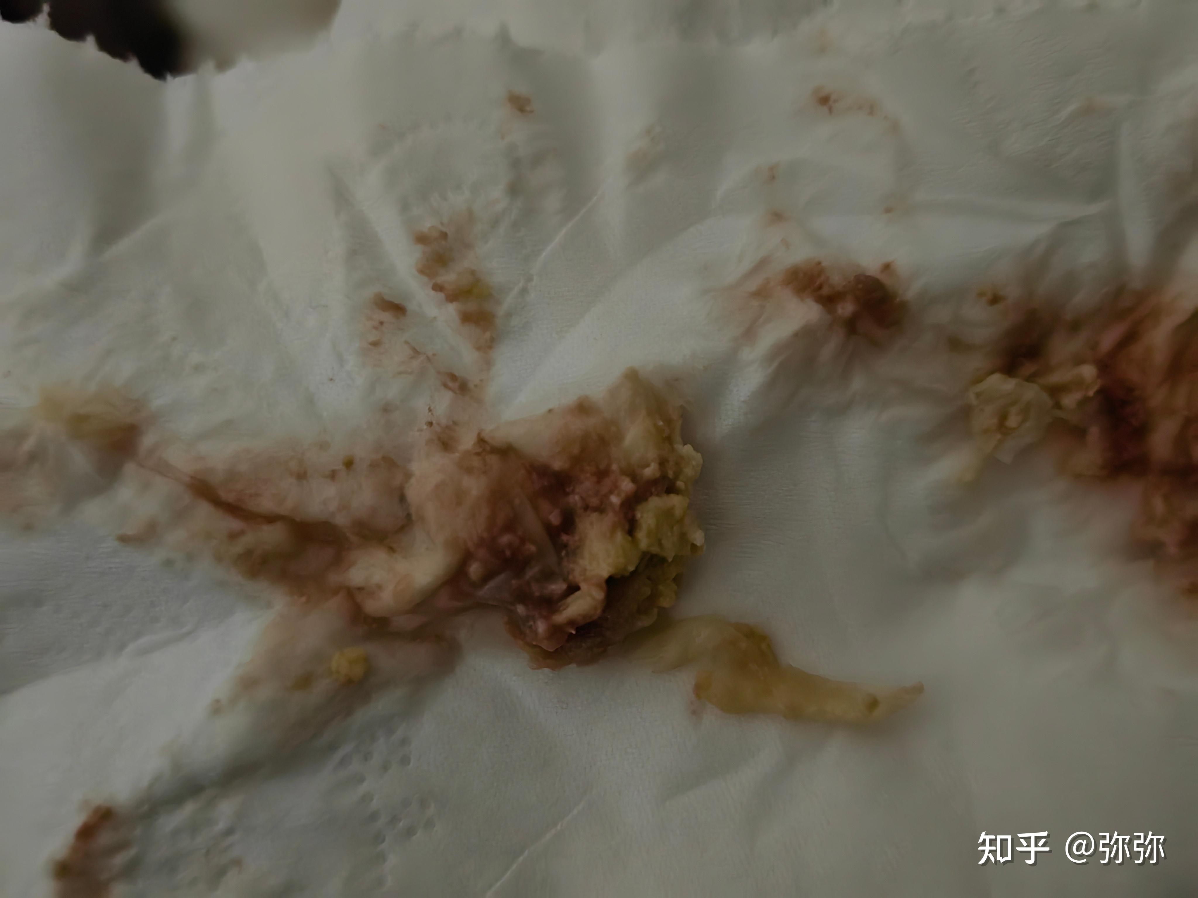 子宫内膜炎排出物图片(子宫内膜炎排出烂肉一样的东西) 子宫内膜炎排出物图片(子宫内膜炎排出烂肉一样的东西)