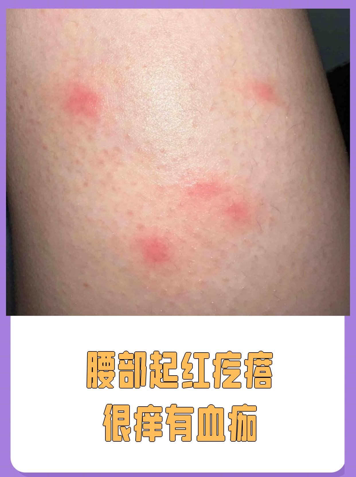 螨虫结痂(螨虫过敏结痂咋办)