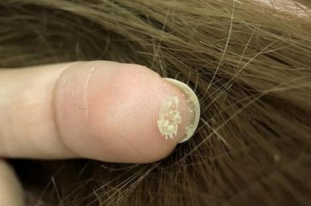 螨虫结痂(螨虫过敏结痂咋办) 螨虫结痂(螨虫过敏结痂咋办)